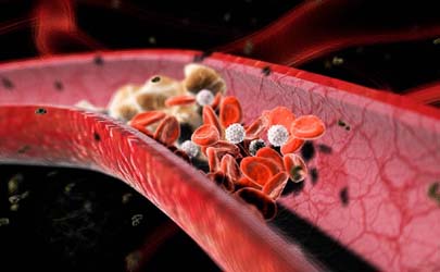 ارتباط بین کلسترول بالا و خطر ابتلا به سرطان سینه 