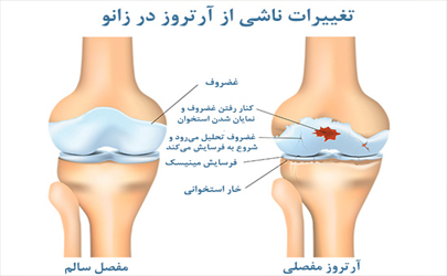 خطر ابتلا به ساییدگی زانو با نشستن چهار زانو/ راه‌های پیشگیری از شایع‌ترین بیماری‌ اسکلتی- عضلانی