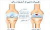خطر ابتلا به ساییدگی زانو با نشستن چهار زانو/ راه‌های پیشگیری از شایع‌ترین بیماری‌ اسکلتی- عضلانی