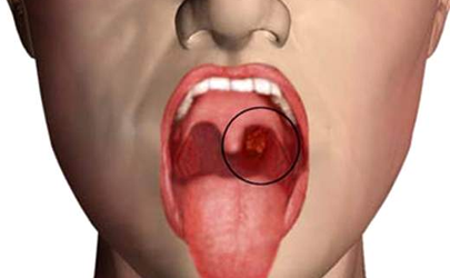 هشدار شیوع سرطان حفره دهان در ایران
