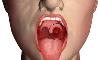 هشدار شیوع سرطان حفره دهان در ایران
