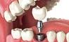 نکات مهم و اساسی درباره کاشت دندان