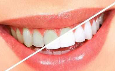 سفید و پر کردن دندان‌ها بدون نیاز به دندانپزشک