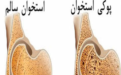 پوکی استخوان یک بیماری بدون درد است